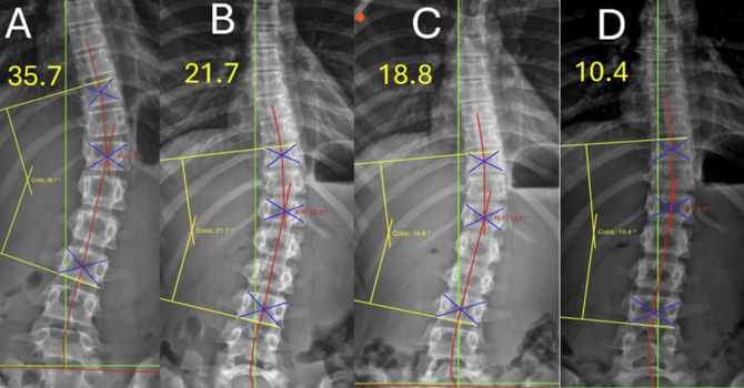 A Non-Surgical Multimodal Approach to Adolescent Idiopathic Scoliosis (Lenke 5C) Using an Intensive Two Week CLEAR Institute Protocol image