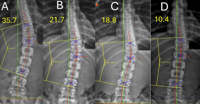 A Non-Surgical Multimodal Approach to Adolescent Idiopathic Scoliosis (Lenke 5C) Using an Intensive Two Week CLEAR Institute Protocol image