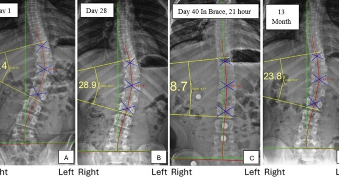 Reduction of Adolescent Idiopathic Scoliosis: A Peer-Reviewed Medical Journal Publication by Dr. Justin M. Dick image