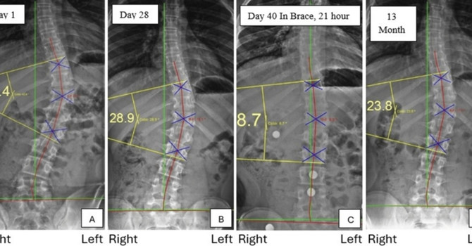 Reduction of Adolescent Idiopathic Scoliosis: A Peer-Reviewed Medical Journal Publication by Dr. Justin M. Dick