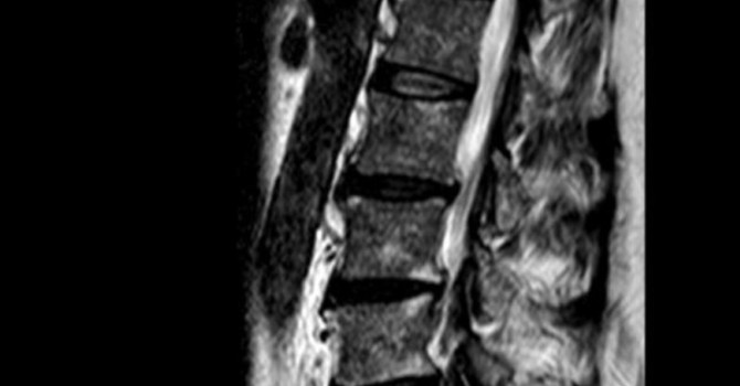A Case Report:  Improved Health Outcomes in a Military Veteran Following Vertebral Subluxation Based Chiropractic Care image