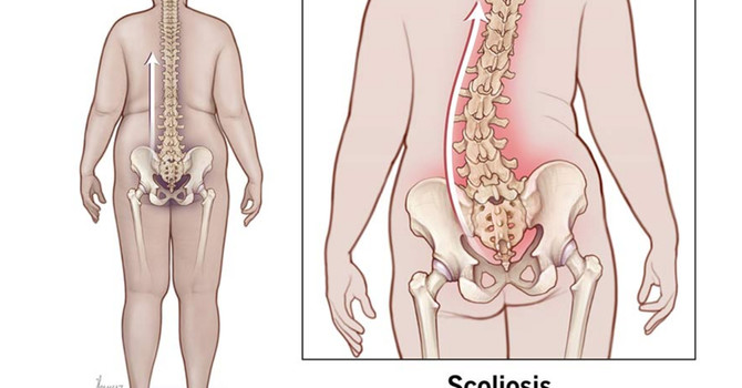 Adult Scoliosis and Curve Severity image