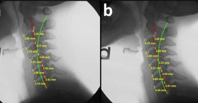 Spine Structure- Pain and Accelerated Degeneration
