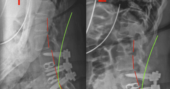 Refractory Lumbar Pain After Motor Vehicle Collision: A Case-Based Analysis of Multimodal Conservative Structural Rehabilitation