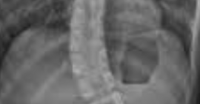 What Does it Feel Like to Have Scoliosis?