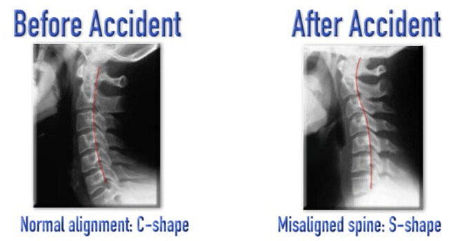What Happens to the Cervical Spine During a Motor Vehicle Collision? Understanding Whiplash Biomechanics