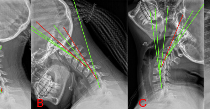 Does Scoliosis Affect Injury Risk During a Car Accident? Biomechanical Considerations
