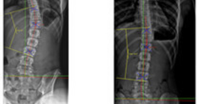 Kinetic Chain Dysfunction in Geriatric Scoliosis