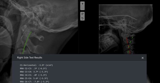 Atlas Position and Déjà Vu — A Clinical Observation at Clear Life Scoliosis Charlotte NC | Dr. Justin Dick