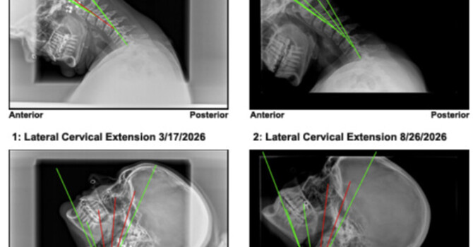 Side-Impact Whiplash Case Review Charlotte NC | Dr. Justin M. Dick, DC | Clear Life Scoliosis